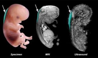 nt是什么检查 nt是什么检查